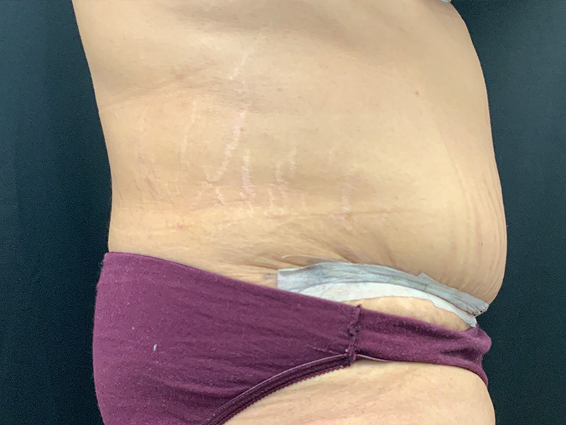 Lymphatic Drainage Massage Before and After | Montilla Plastic Surgery