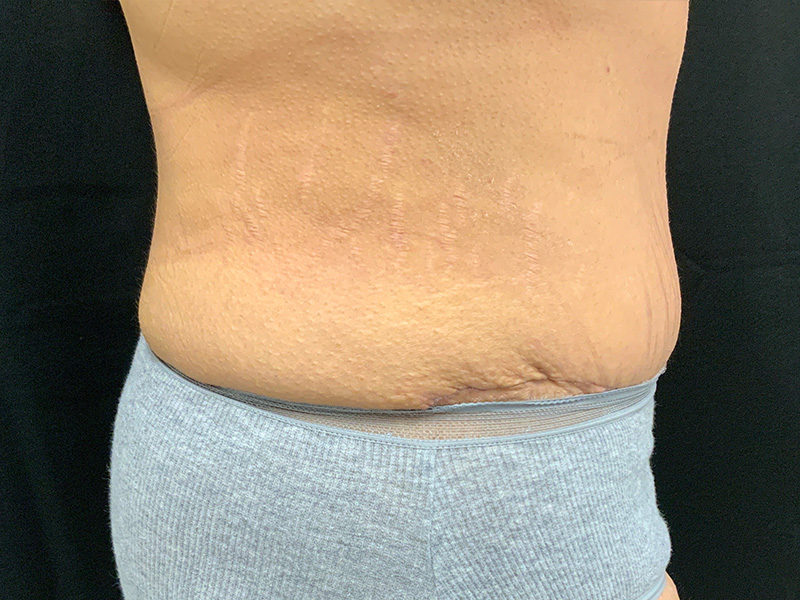 Lymphatic Drainage Massage Before and After | Montilla Plastic Surgery