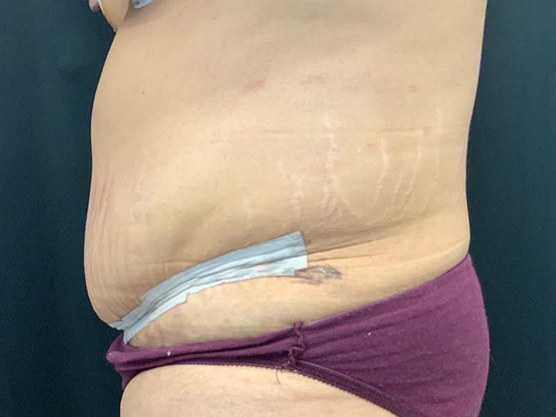 Lymphatic Drainage Massage Before and After | Montilla Plastic Surgery