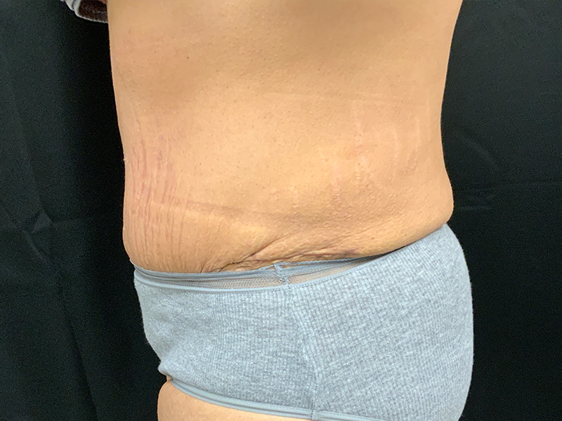 Lymphatic Drainage Massage Before and After | Montilla Plastic Surgery