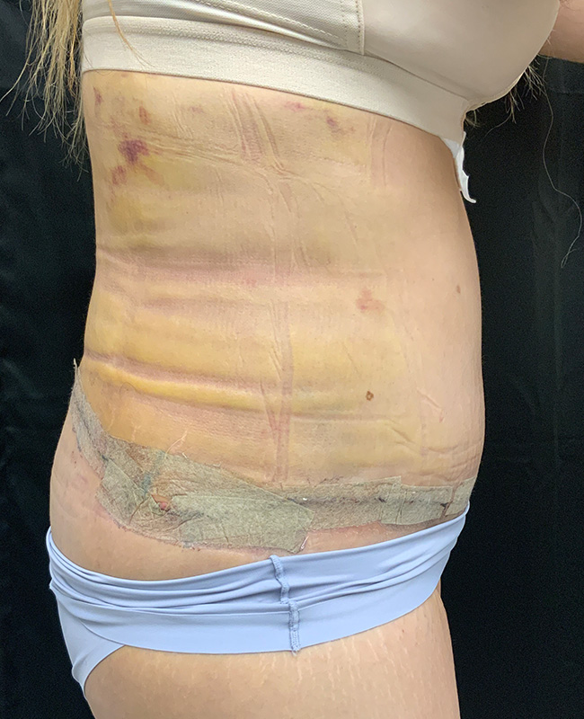 Lymphatic Drainage Massage Before and After | Montilla Plastic Surgery