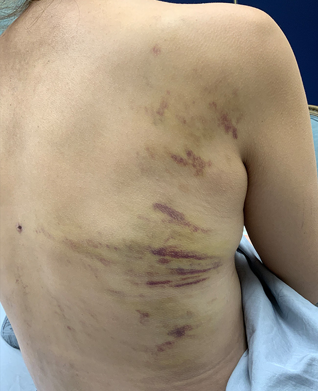 Lymphatic Drainage Massage Before and After | Montilla Plastic Surgery