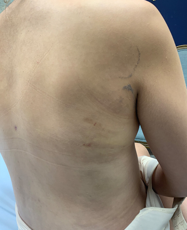 Lymphatic Drainage Massage Before and After | Montilla Plastic Surgery