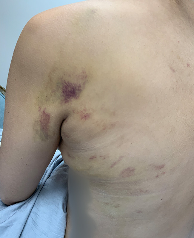 Lymphatic Drainage Massage Before and After | Montilla Plastic Surgery