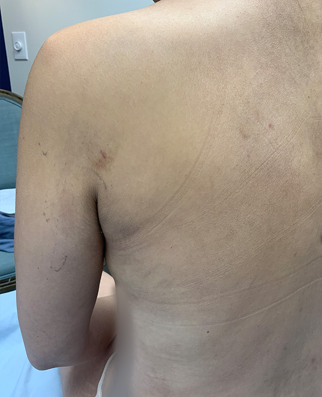 Lymphatic Drainage Massage Before and After | Montilla Plastic Surgery