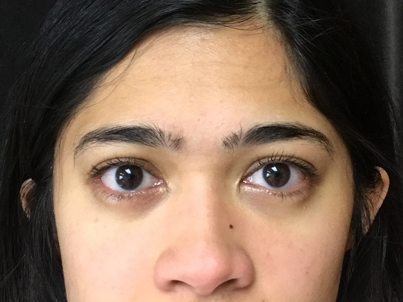 Mole Excision Before and After | Montilla Plastic Surgery 
