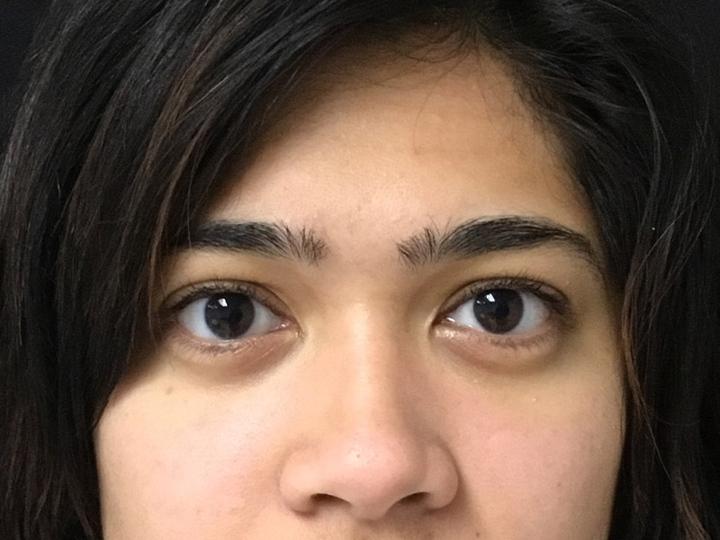 Mole Excision Before and After | Montilla Plastic Surgery 