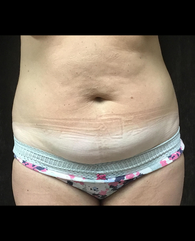 Mommy Makeover Before and After | Montilla Plastic Surgery 