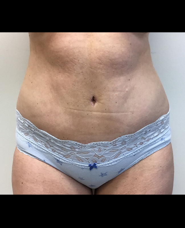 Mommy Makeover Before and After | Montilla Plastic Surgery 