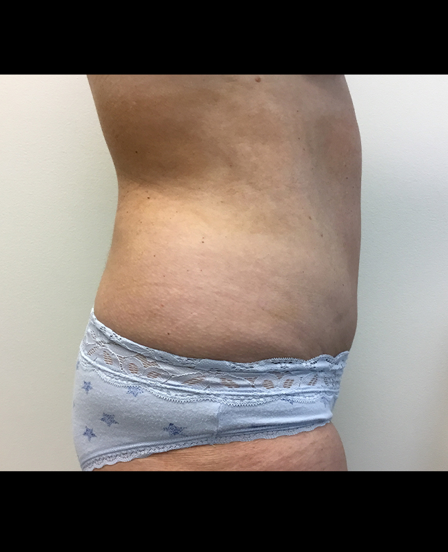 Mommy Makeover Before and After | Montilla Plastic Surgery 