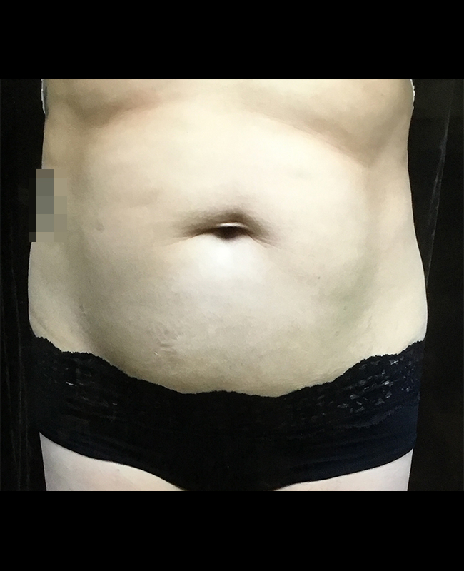 Mommy Makeover Before and After | Montilla Plastic Surgery 