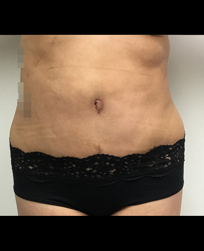 Mommy Makeover Before and After | Montilla Plastic Surgery 