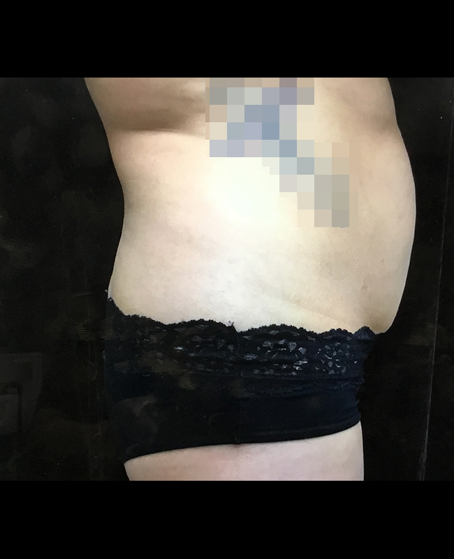 Mommy Makeover Before and After | Montilla Plastic Surgery