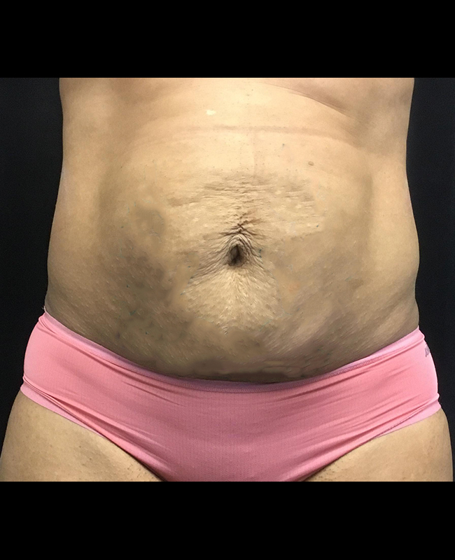 Mommy Makeover Before and After | Montilla Plastic Surgery 
