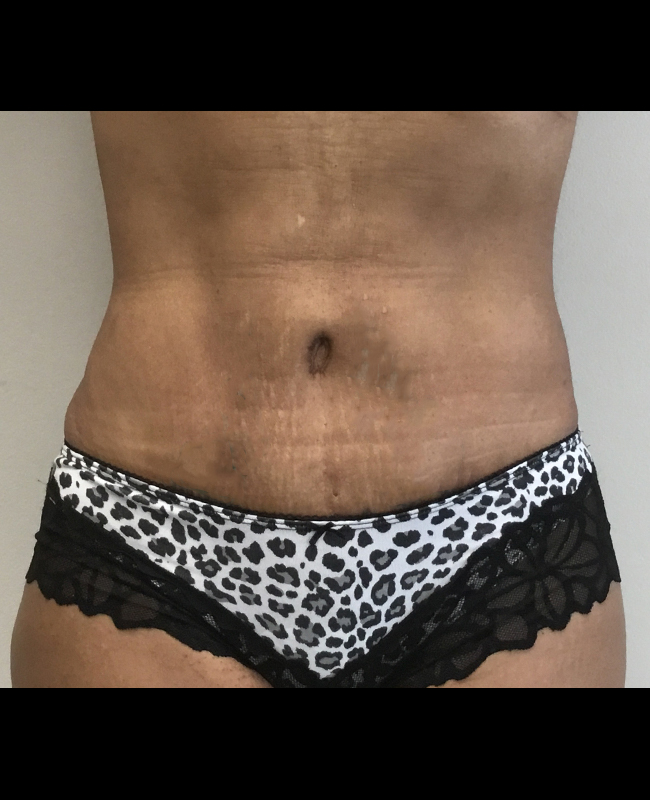 Mommy Makeover Before and After | Montilla Plastic Surgery 