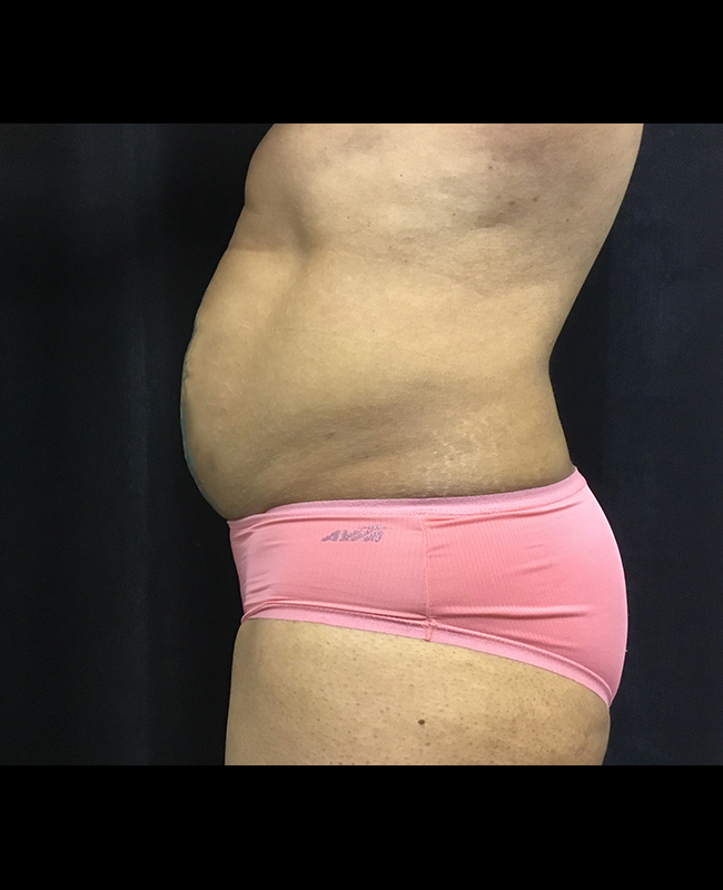 Mommy Makeover Before and After | Montilla Plastic Surgery