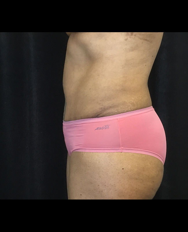 Mommy Makeover Before and After | Montilla Plastic Surgery