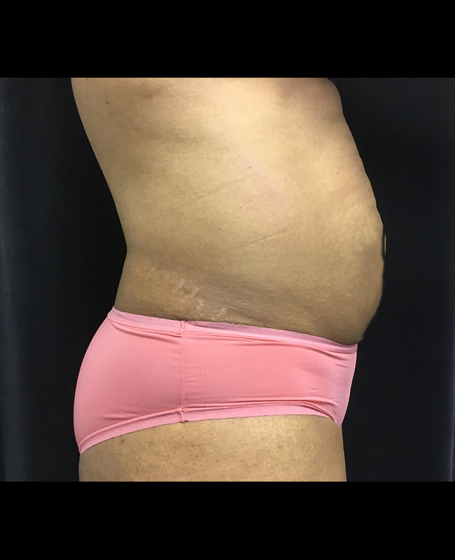 Mommy Makeover Before and After | Montilla Plastic Surgery