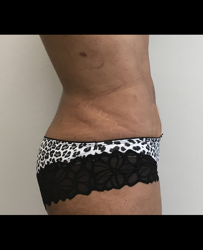 Mommy Makeover Before and After | Montilla Plastic Surgery