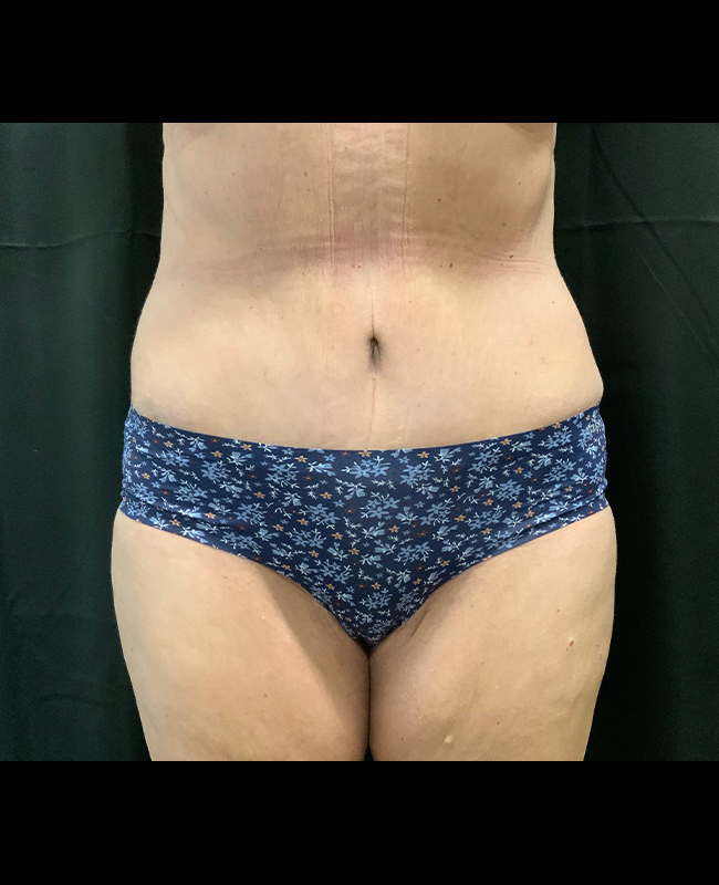 Mommy Makeover Before and After | Montilla Plastic Surgery 
