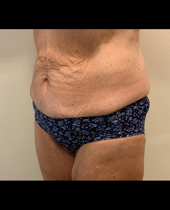 Mommy Makeover Before and After | Montilla Plastic Surgery