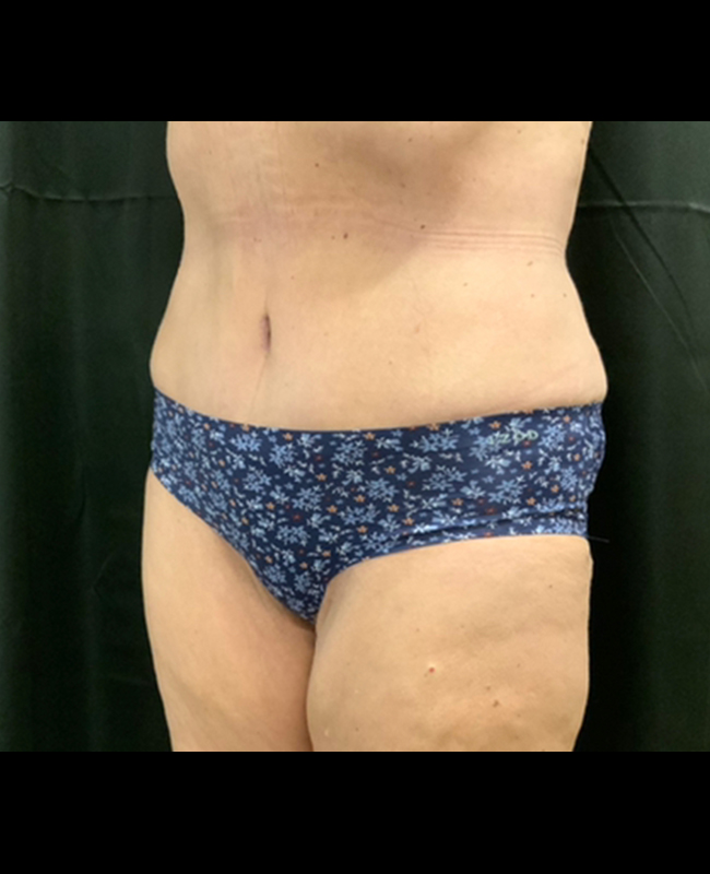 Mommy Makeover Before and After | Montilla Plastic Surgery