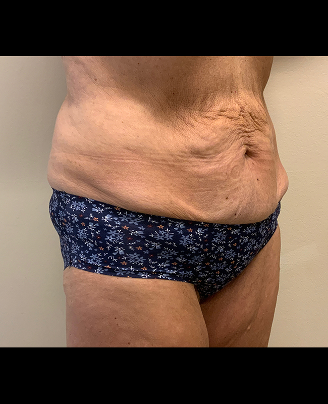 Mommy Makeover Before and After | Montilla Plastic Surgery