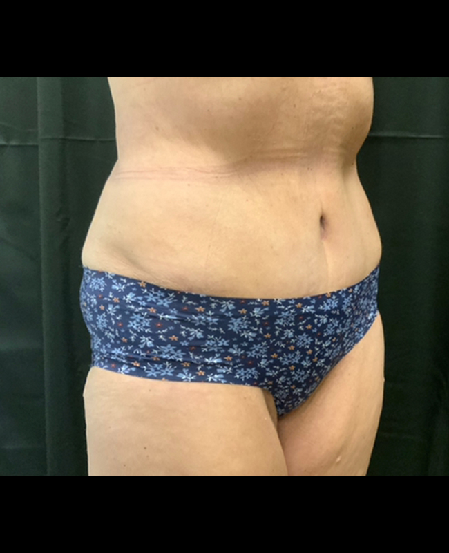 Mommy Makeover Before and After | Montilla Plastic Surgery
