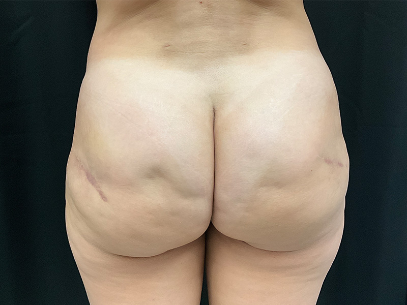 Morpheus 8 Before and After | Montilla Plastic Surgery