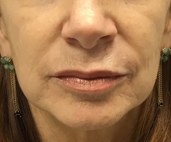 Nasolabial Fillers Before and After | Montilla Plastic Surgery 
