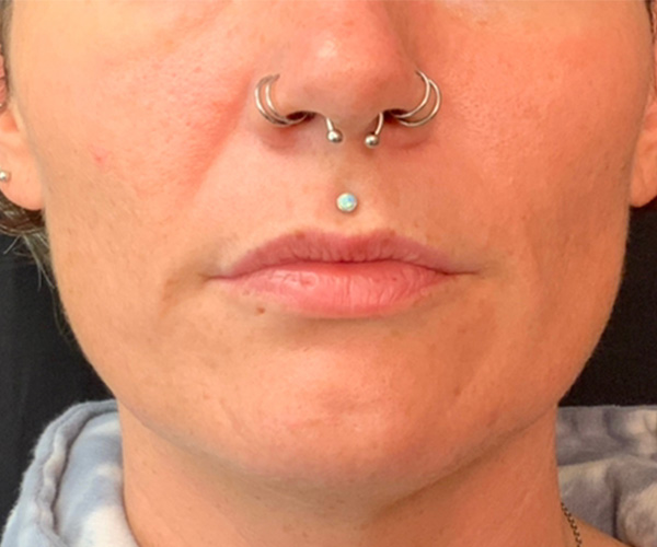 Nasolabial Fillers Before and After | Montilla Plastic Surgery 