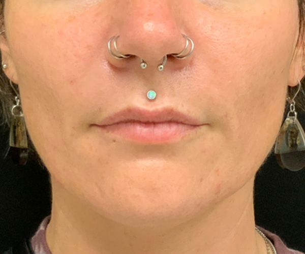 Nasolabial Fillers Before and After | Montilla Plastic Surgery 