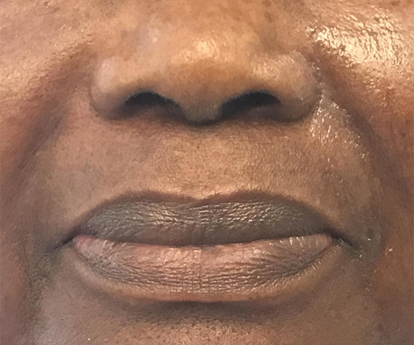 Nasolabial Fillers Before and After | Montilla Plastic Surgery 