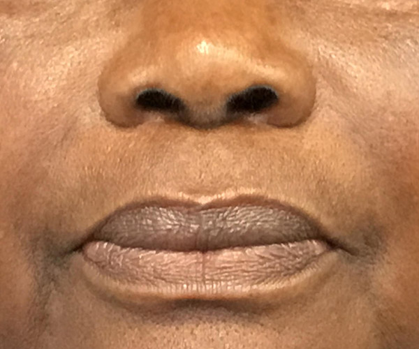 Nasolabial Fillers Before and After | Montilla Plastic Surgery 