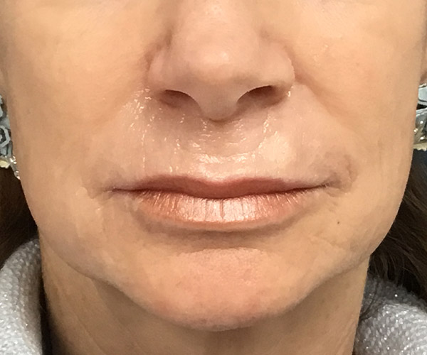 Nasolabial Fillers Before and After | Montilla Plastic Surgery 