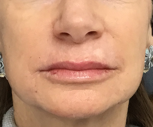 Nasolabial Fillers Before and After | Montilla Plastic Surgery 