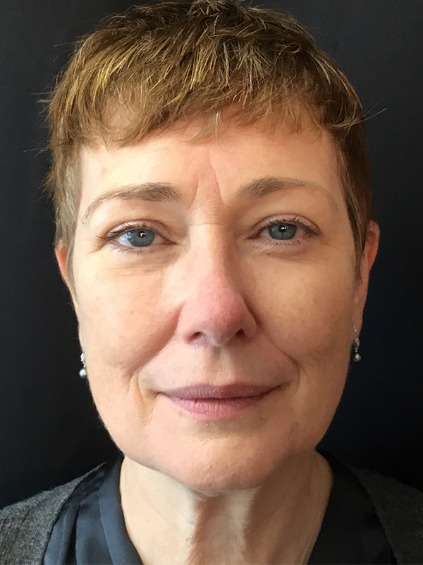 Neck Lift Before and After | Montilla Plastic Surgery 