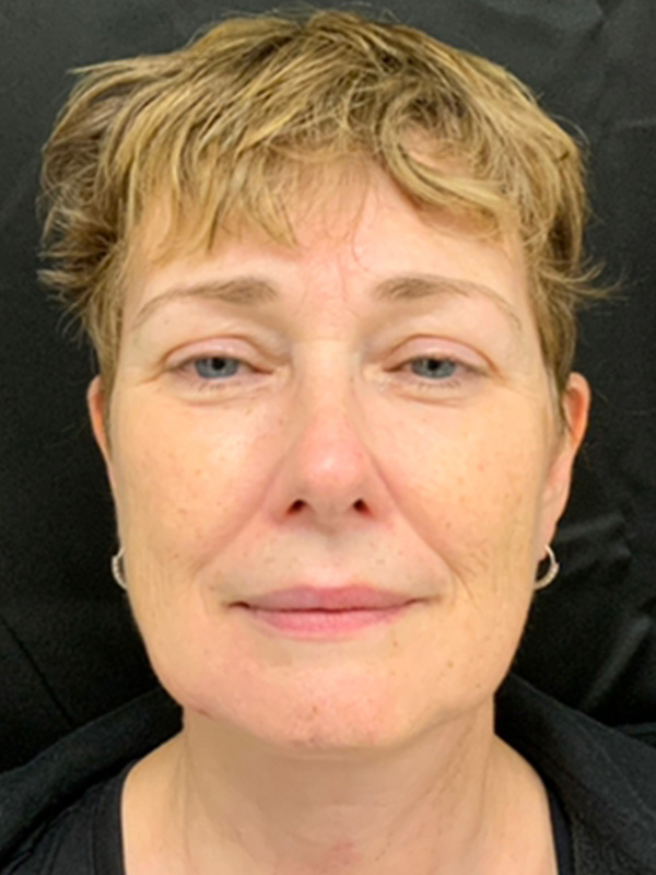 Neck Lift Before and After | Montilla Plastic Surgery 