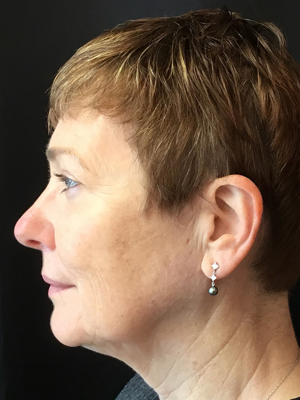 Neck Lift Before and After | Montilla Plastic Surgery 