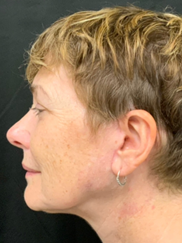 Neck Lift Before and After | Montilla Plastic Surgery 