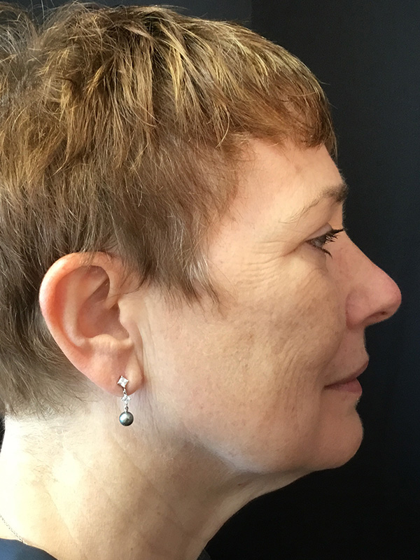 Neck Lift Before and After | Montilla Plastic Surgery 