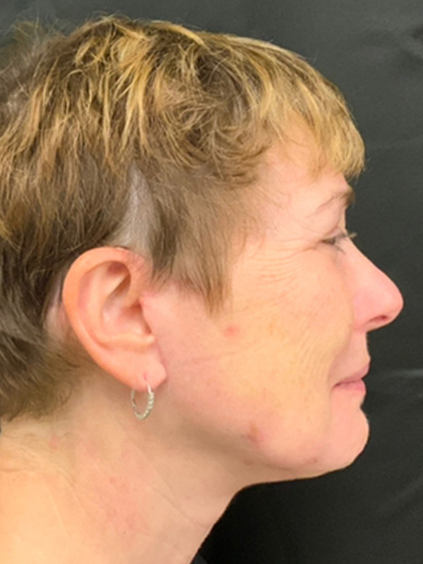 Neck Lift Before and After | Montilla Plastic Surgery 