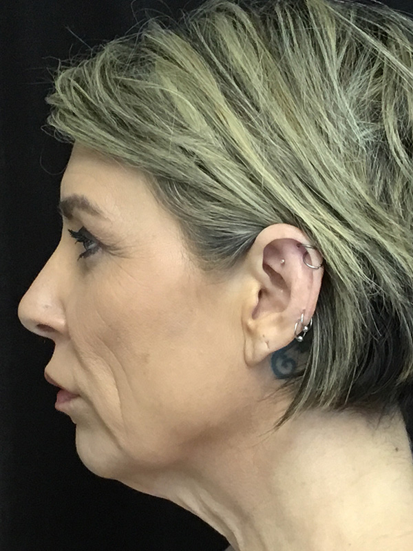 Neck Lift Before and After | Montilla Plastic Surgery 