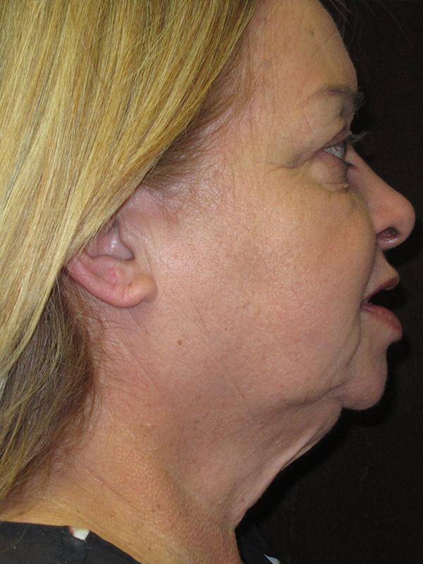 Neck Lift Before and After | Montilla Plastic Surgery 