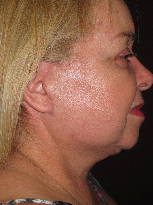 Neck Lift Before and After | Montilla Plastic Surgery 