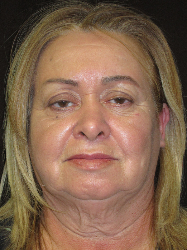 Neck Lift Before and After | Montilla Plastic Surgery