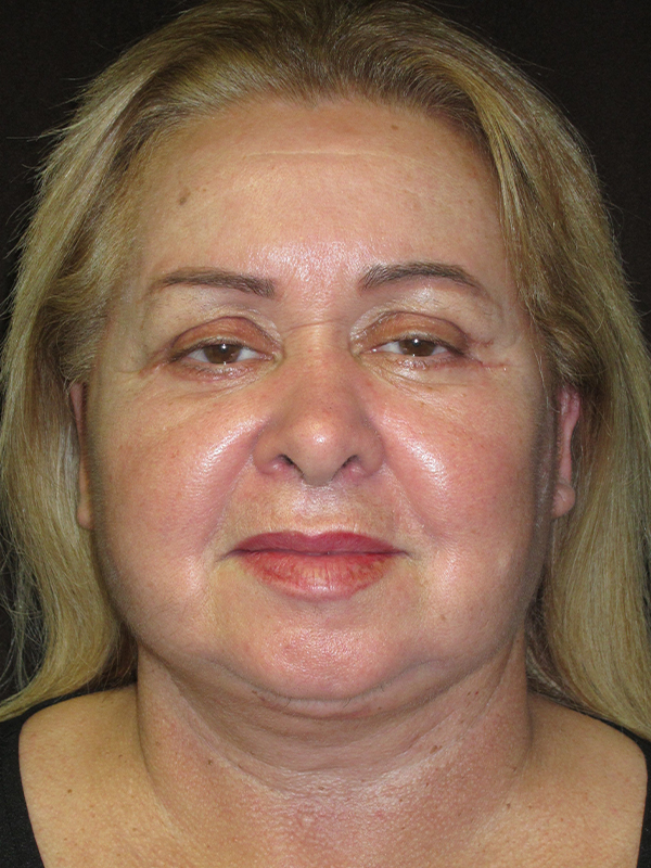 Neck Lift Before and After | Montilla Plastic Surgery