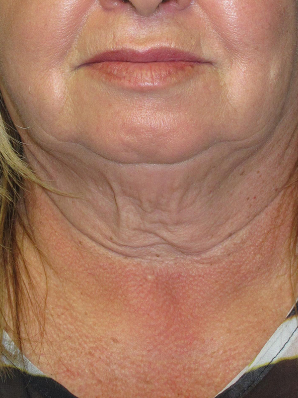 Neck Lift Before and After | Montilla Plastic Surgery