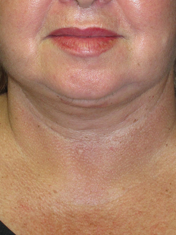 Neck Lift Before and After | Montilla Plastic Surgery