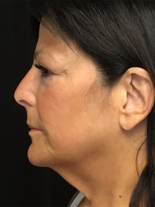 Neck Lift Before and After | Montilla Plastic Surgery 